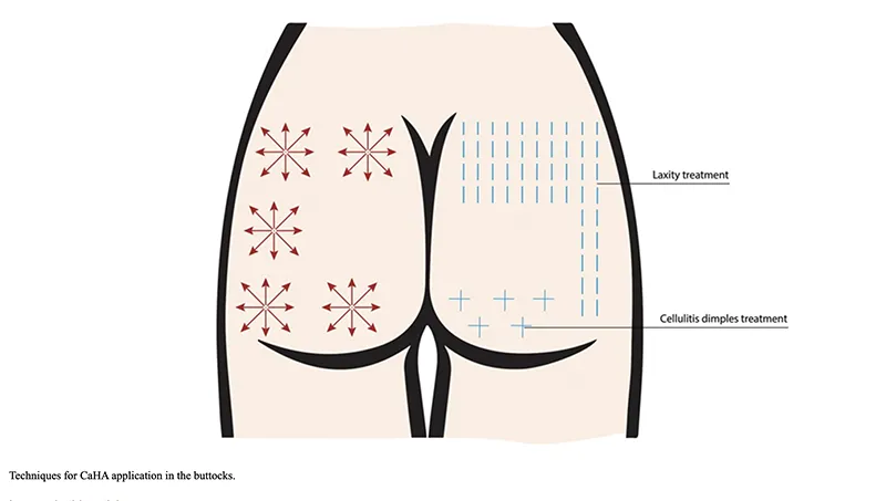 Techniques for CaHa in buttocks
