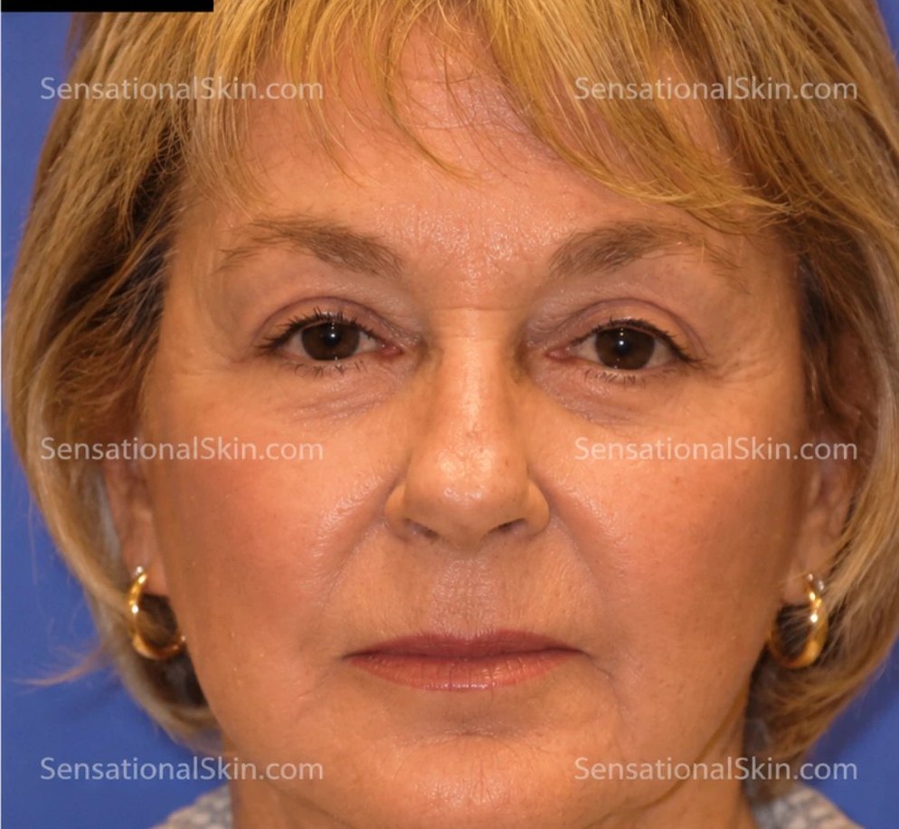 After Liquid Facelift