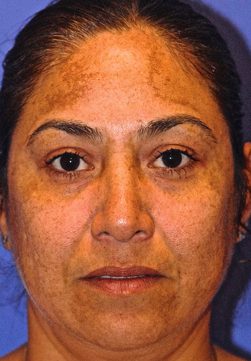 Before treatment