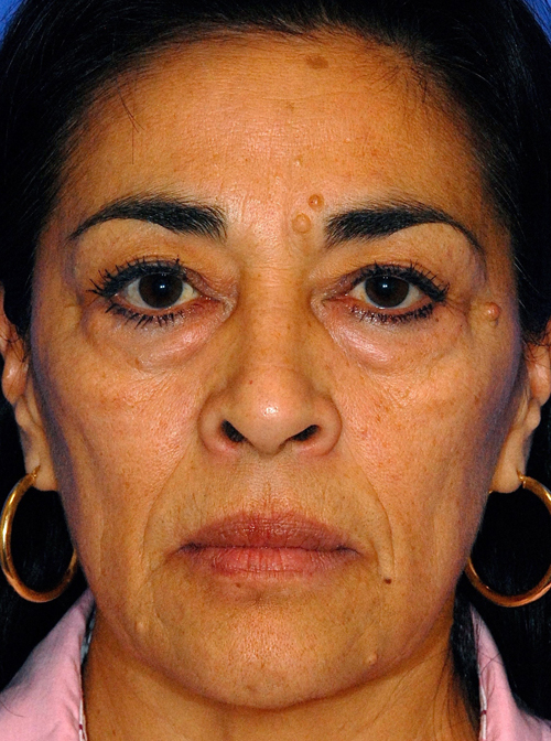 Before Liquid Facelift