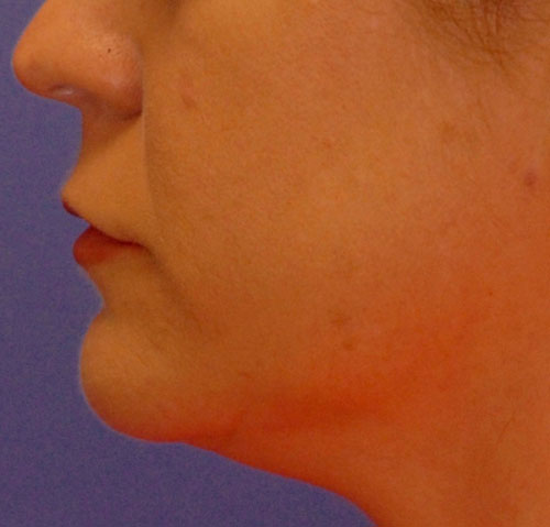 After Ultherapy