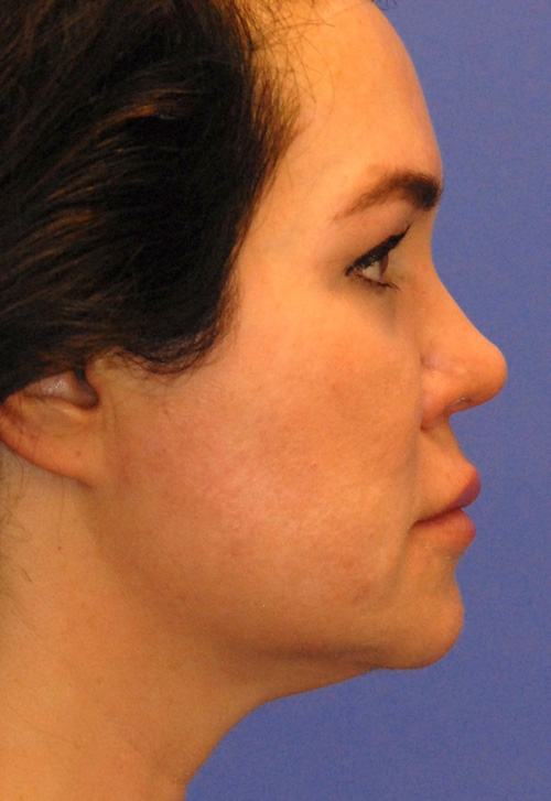 After Profound RF