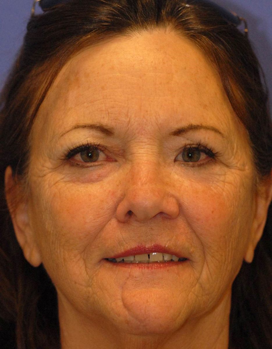 Before Laser Resurfacing