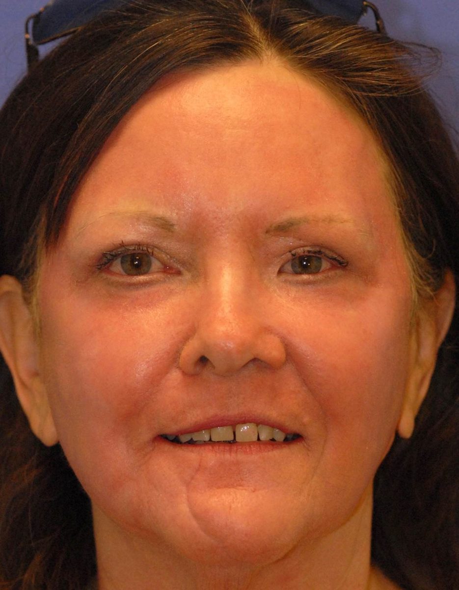 After Laser Resurfacing