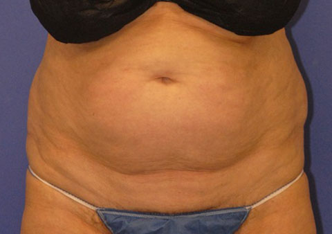 Before CoolSculpting