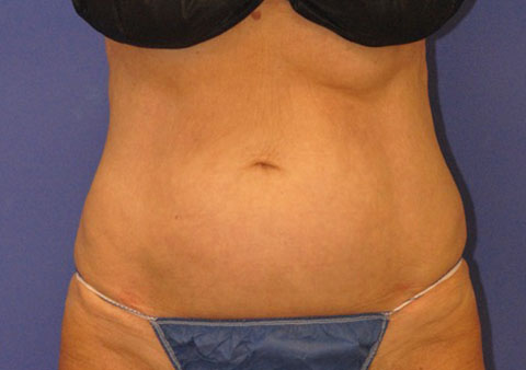 After CoolSculpting