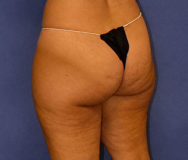 Before Weight Loss